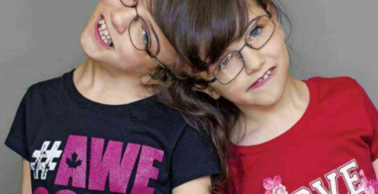 Meet Tatiana and Krista Hogan: The Unique Conjoined Twins from British Columbia, Canada | MirrorLog